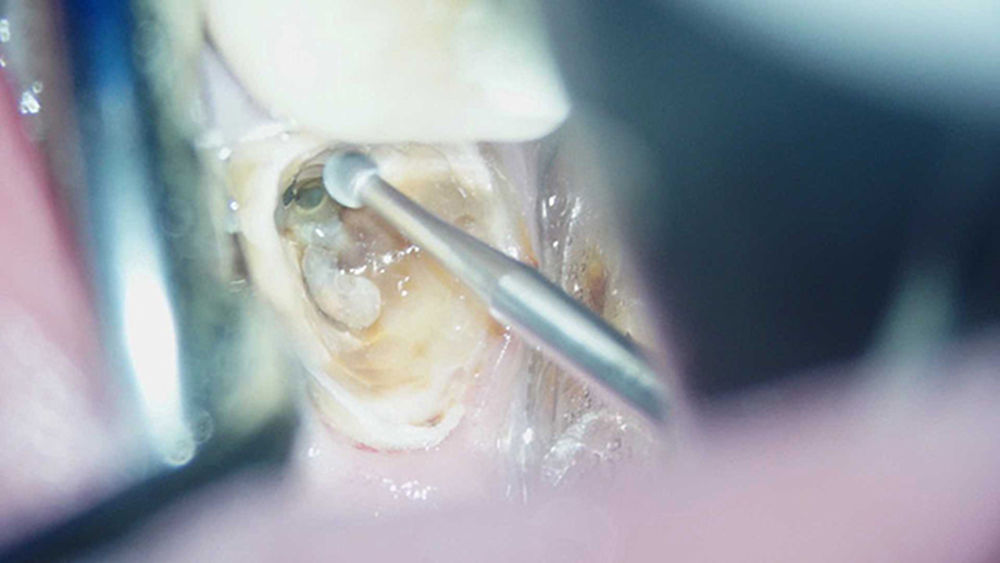 STEP3.虫歯部分の削合