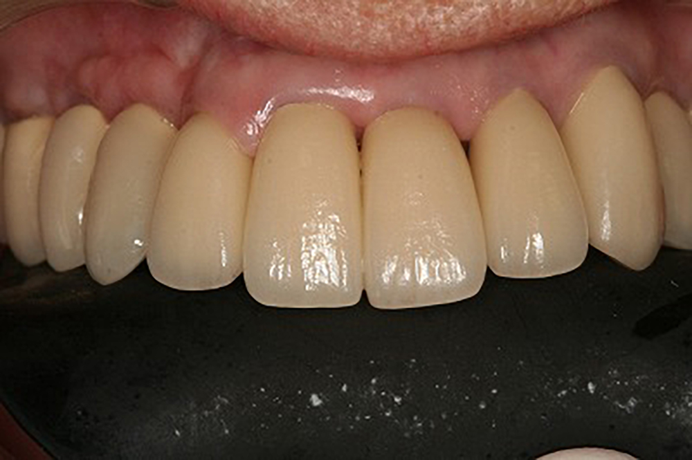 矯正治療＋歯のカモフラージュ＋セラモメタルクラウン治療例