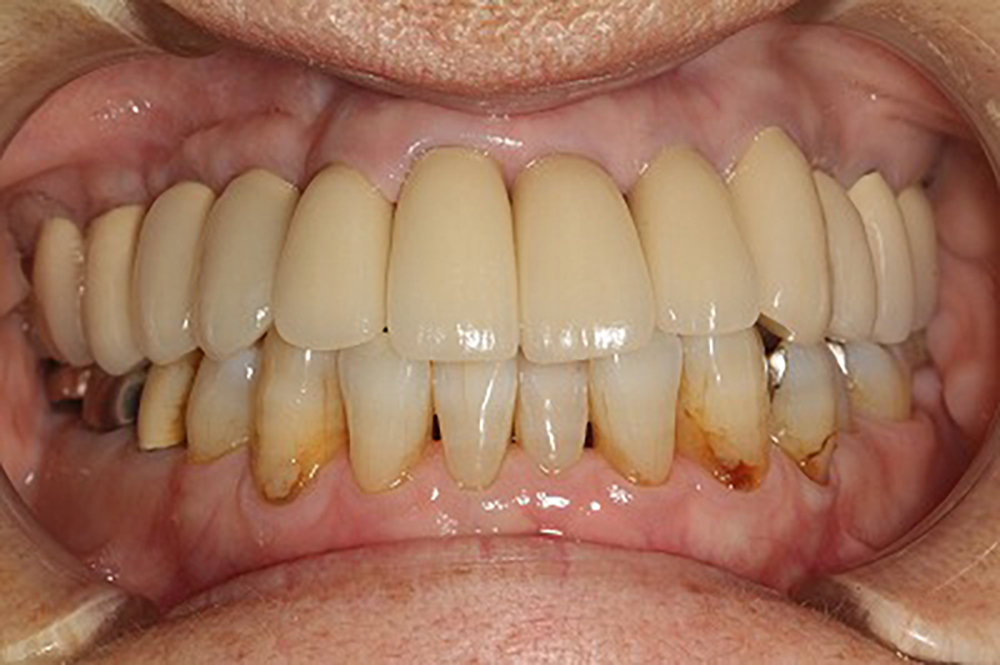 矯正治療＋歯のカモフラージュ＋セラモメタルクラウン治療例
